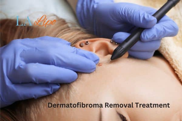 Dermatofibroma Removal Treatment Oakham