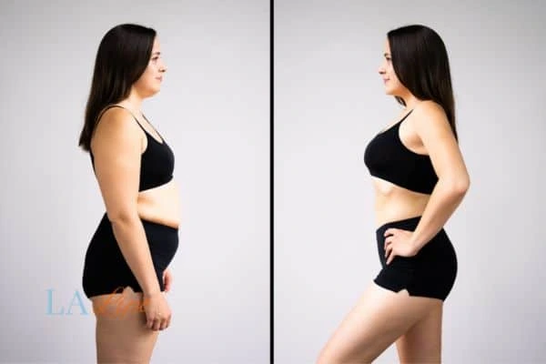 image of woman before and after results of LA-EMS Body Sculpting Oakham to help treat Diastasis recti