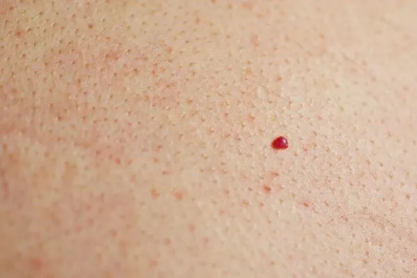 close up of a cherry angioma Oakham