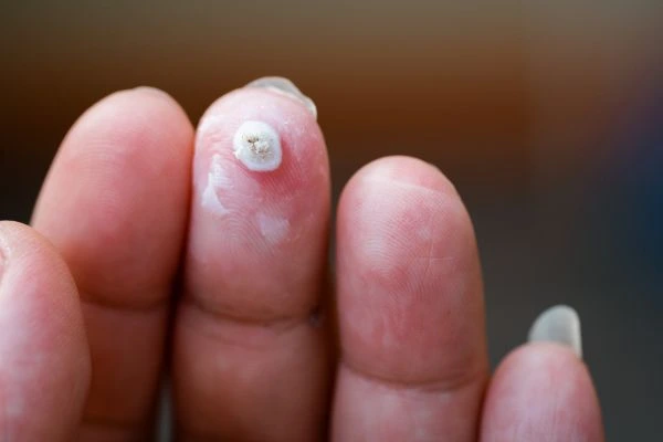 wart on person finger - cryotherapy to treat from LA LIPO Oakham