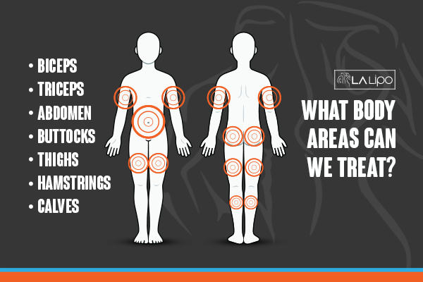 Diagram to show areas you can have LA-EMS Body Sculpting Treatment Oakham